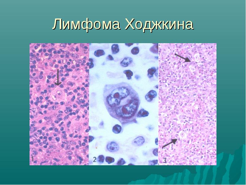 Лимфомы Ходжкина: стадии и прогноз болезни