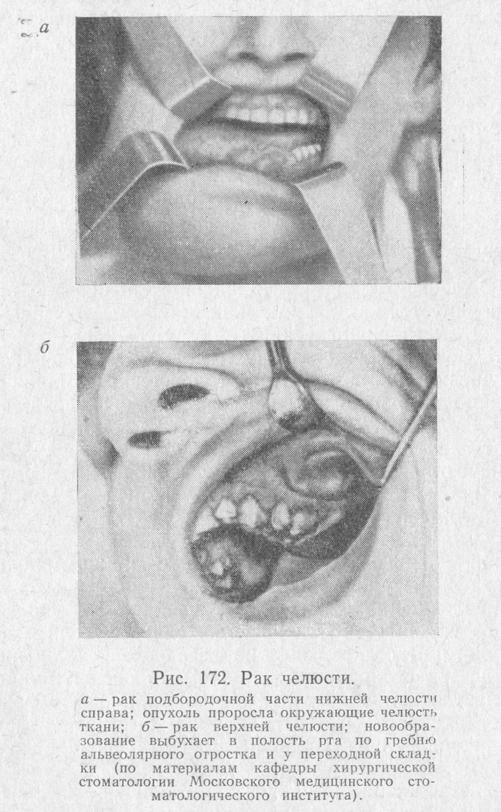 Рак челюсти: симптомы и лечение