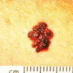 Меланома 4 стадии