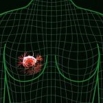 Для лечения рака груди потребуется индивидуальный подход