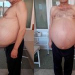 У мужчины из Перми удалили 30-килограммовую опухоль